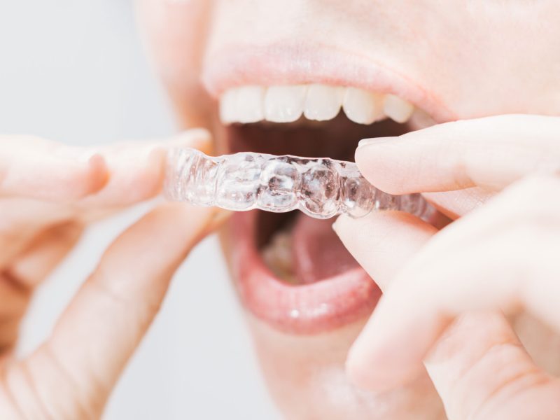 closeup of woman's mouth putting on a transparent retainer with soft natural lighting